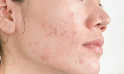 Dermatoloğa paralar dökmenize gerek yok! Yağ bezelerini sivilceleri söküp atacak yöntem...