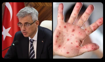 Maymun Çiçeği Virüsü Tehlikesine Karşı Sağlık Sistemi Hazır mı? Bakan Memişoğlu’ndan Net Mesaj!