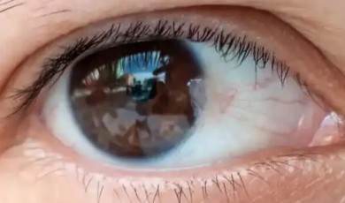 Gözde Kanlanma ve Kızarıklığa Dikkat: Altından Pterjium Çıkabilir
